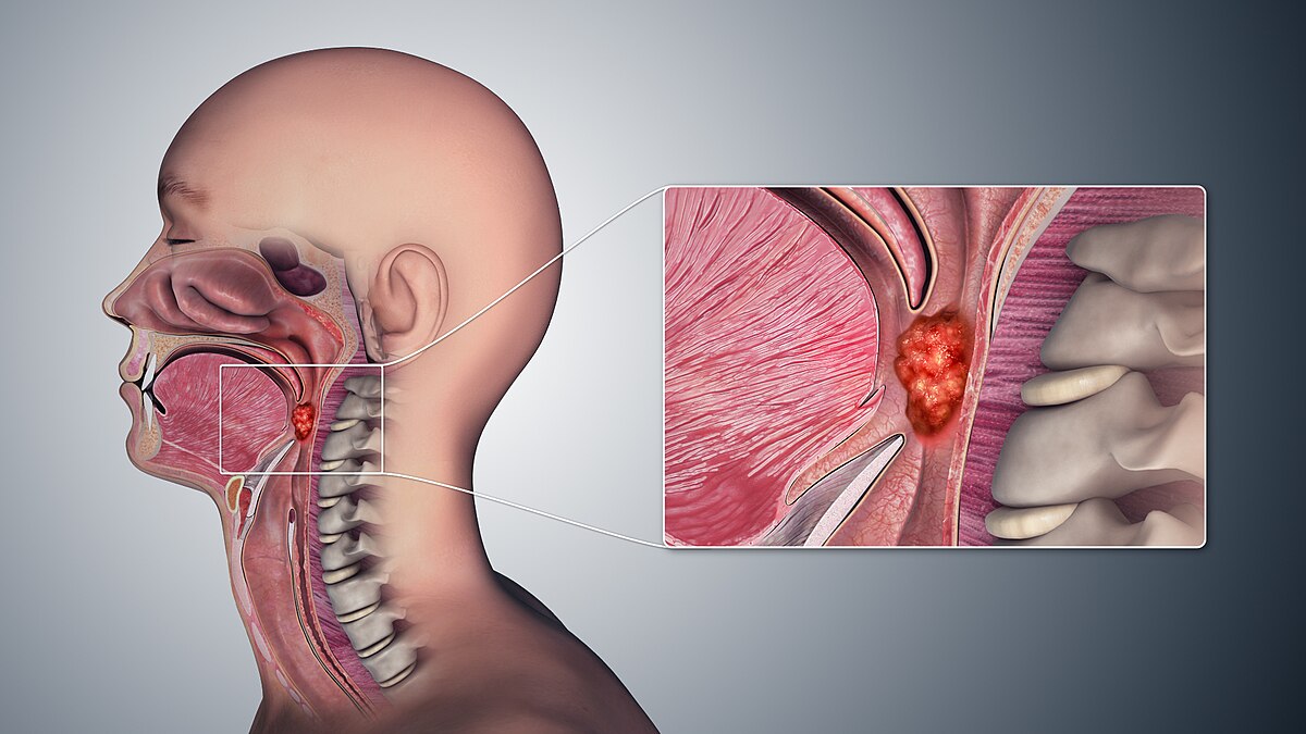 Throat Cancer Symptoms